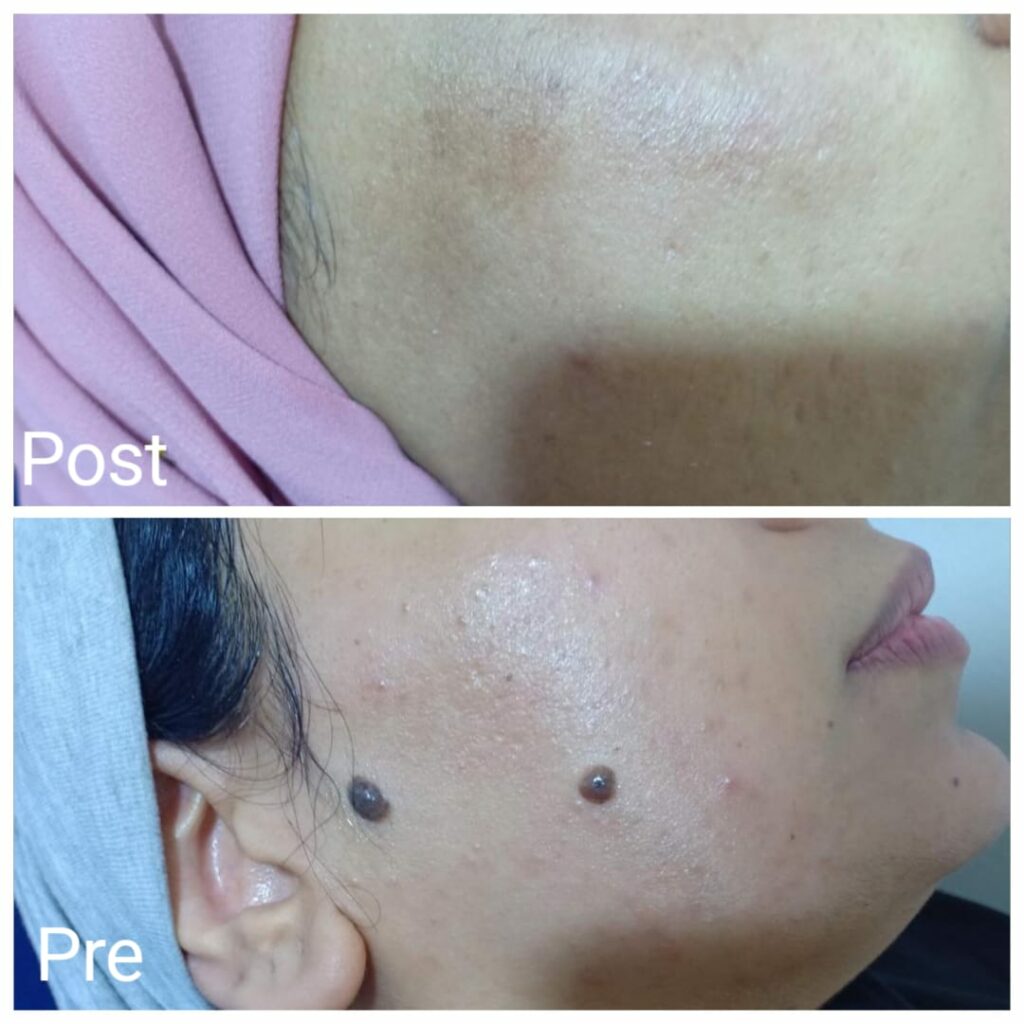 Laser skin tag removal